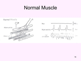 16
Normal Muscle
 