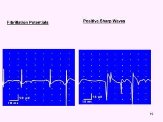 19
Fibrillation Potentials Positive Sharp Waves
 