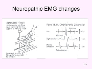 23
Neuropathic EMG changes
 