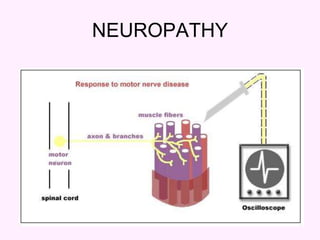 24
NEUROPATHY
 