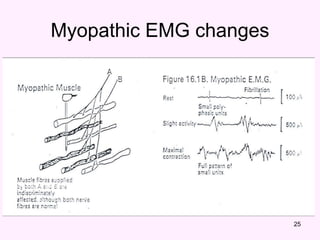 25
Myopathic EMG changes
 