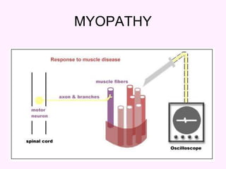 26
MYOPATHY
 