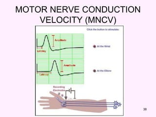 38
MOTOR NERVE CONDUCTION
VELOCITY (MNCV)
 