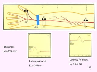 40
Latency At wrist
L2 = 3.5 ms
Latency At elbow
L1 = 8.5 ms
Distance
d = 284 mm
 