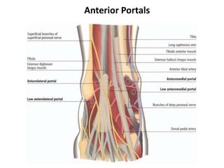 Anterior Portals
 