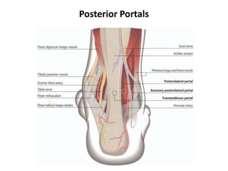 Posterior Portals
 