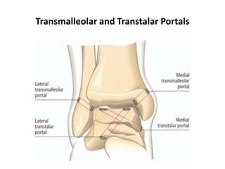 Transmalleolar and Transtalar Portals
 