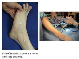 Path of superficial peroneal nerve
is marked on ankle.
 