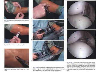 Arthroscopy of Ankle and Wrist