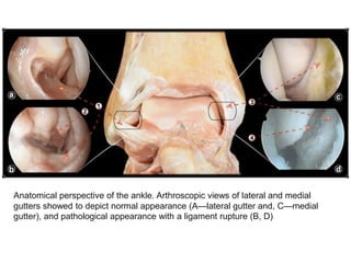 Anatomical perspective of the ankle. Arthroscopic views of lateral and medial
gutters showed to depict normal appearance (A—lateral gutter and, C—medial
gutter), and pathological appearance with a ligament rupture (B, D)
 