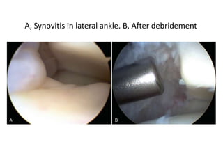 A, Synovitis in lateral ankle. B, After debridement
 
