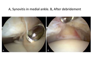 A, Synovitis in medial ankle. B, After debridement
 