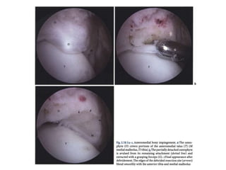 Arthroscopy of Ankle and Wrist