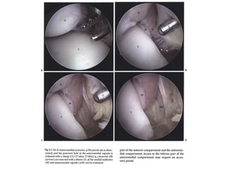 Arthroscopy of Ankle and Wrist