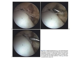Arthroscopy of Ankle and Wrist