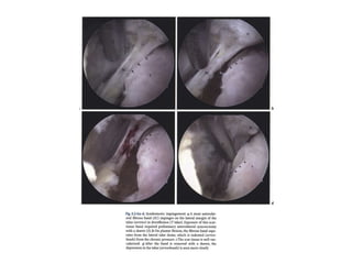 Arthroscopy of Ankle and Wrist