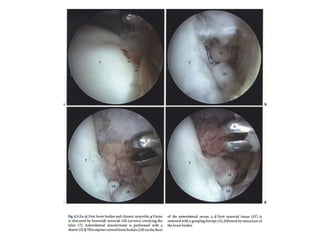 Arthroscopy of Ankle and Wrist