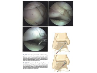 Arthroscopy of Ankle and Wrist