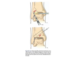 Arthroscopy of Ankle and Wrist