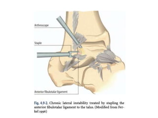 Arthroscopy of Ankle and Wrist