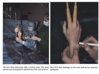 Arthroscopy of Ankle and Wrist