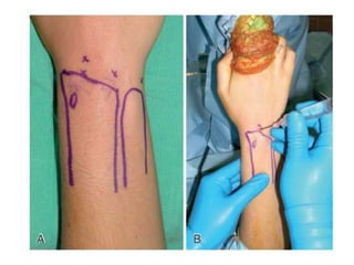 Arthroscopy of Ankle and Wrist