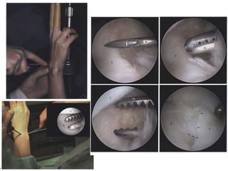 Arthroscopy of Ankle and Wrist