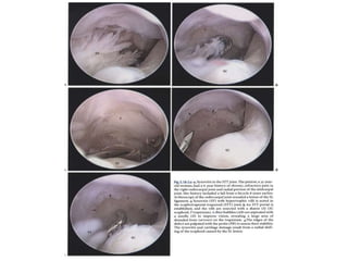 Arthroscopy of Ankle and Wrist