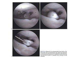 Arthroscopy of Ankle and Wrist