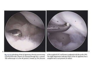 Arthroscopy of Ankle and Wrist