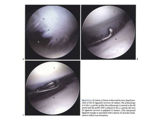 Arthroscopy of Ankle and Wrist
