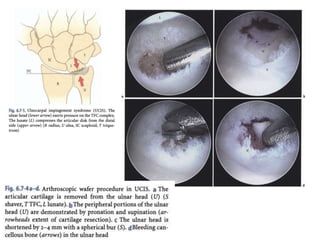 Arthroscopy of Ankle and Wrist