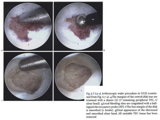 Arthroscopy of Ankle and Wrist