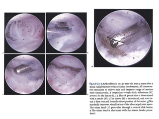 Arthroscopy of Ankle and Wrist