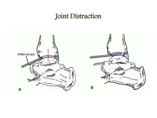 Joint Distraction
 