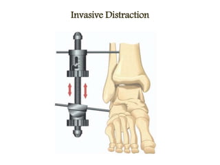 Invasive Distraction
 