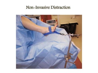 Non-Invasive Distraction
 