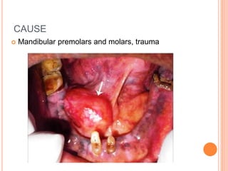 CAUSE
 Mandibular premolars and molars, trauma
 