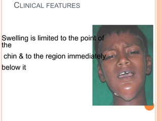 CLINICAL FEATURES
Swelling is limited to the point of
the
chin & to the region immediately
below it
 