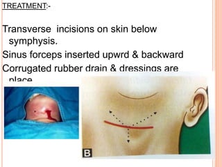TREATMENT:-
Transverse incisions on skin below
symphysis.
Sinus forceps inserted upwrd & backward
Corrugated rubber drain & dressings are
place.
 