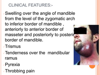 CLINICAL FEATURES:-
Swelling over the angle of mandible
from the level of the zygomatic arch
to inferior border of mandible ,
anteriorly to anterior border of
masseter and posteriorly to posterior
border of mandible.
Trismus
Tenderness over the mandibular
ramus
Pyrexia
Throbbing pain
 