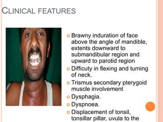 CLINICAL FEATURES
 Brawny induration of face
above the angle of mandible,
extents downward to
submandibular region and
upward to parotid region
 Difficuty in flexing and turning
of neck.
 Trismus secondary pterygoid
muscle involvement
 Dysphagia.
 Dyspnoea.
 Displacement of tonsil,
tonsillar pillar, uvula to the
 