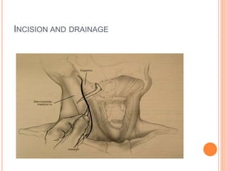 INCISION AND DRAINAGE
 