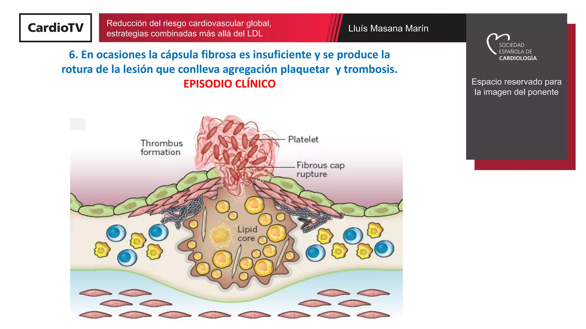 Fisiopatología de la placa de ateroma | PDF