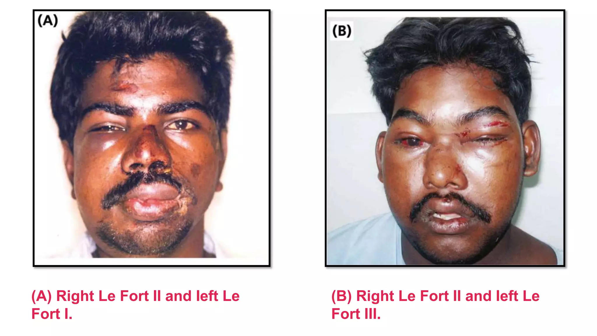 20
(A) Right Le Fort II and left Le
Fort I.
(B) Right Le Fort II and left Le
Fort III.
 