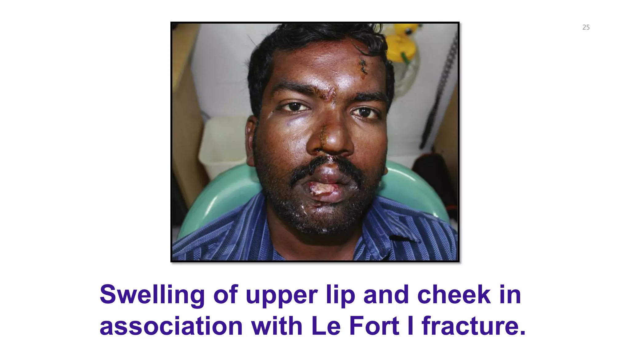 25
Swelling of upper lip and cheek in
association with Le Fort I fracture.
 
