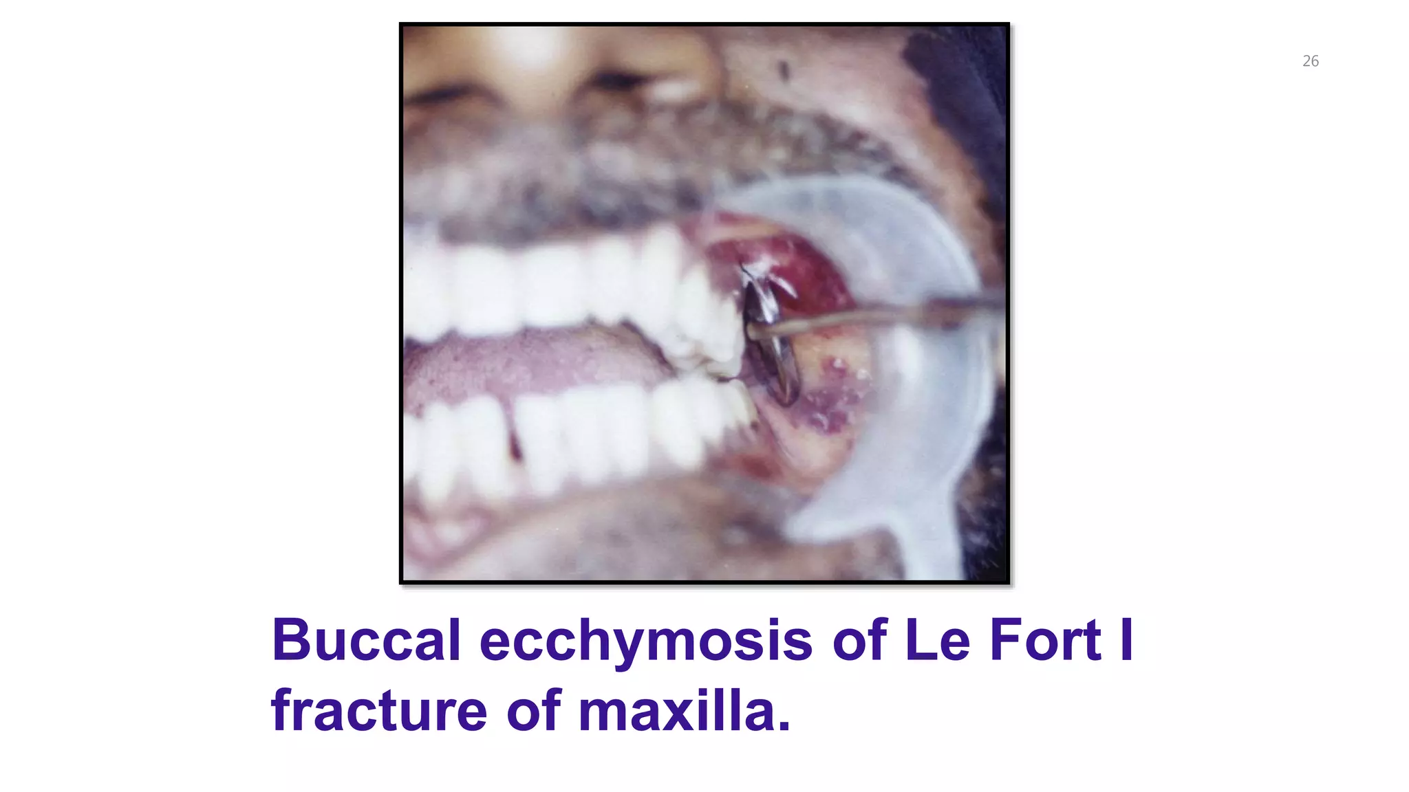 26
Buccal ecchymosis of Le Fort I
fracture of maxilla.
 