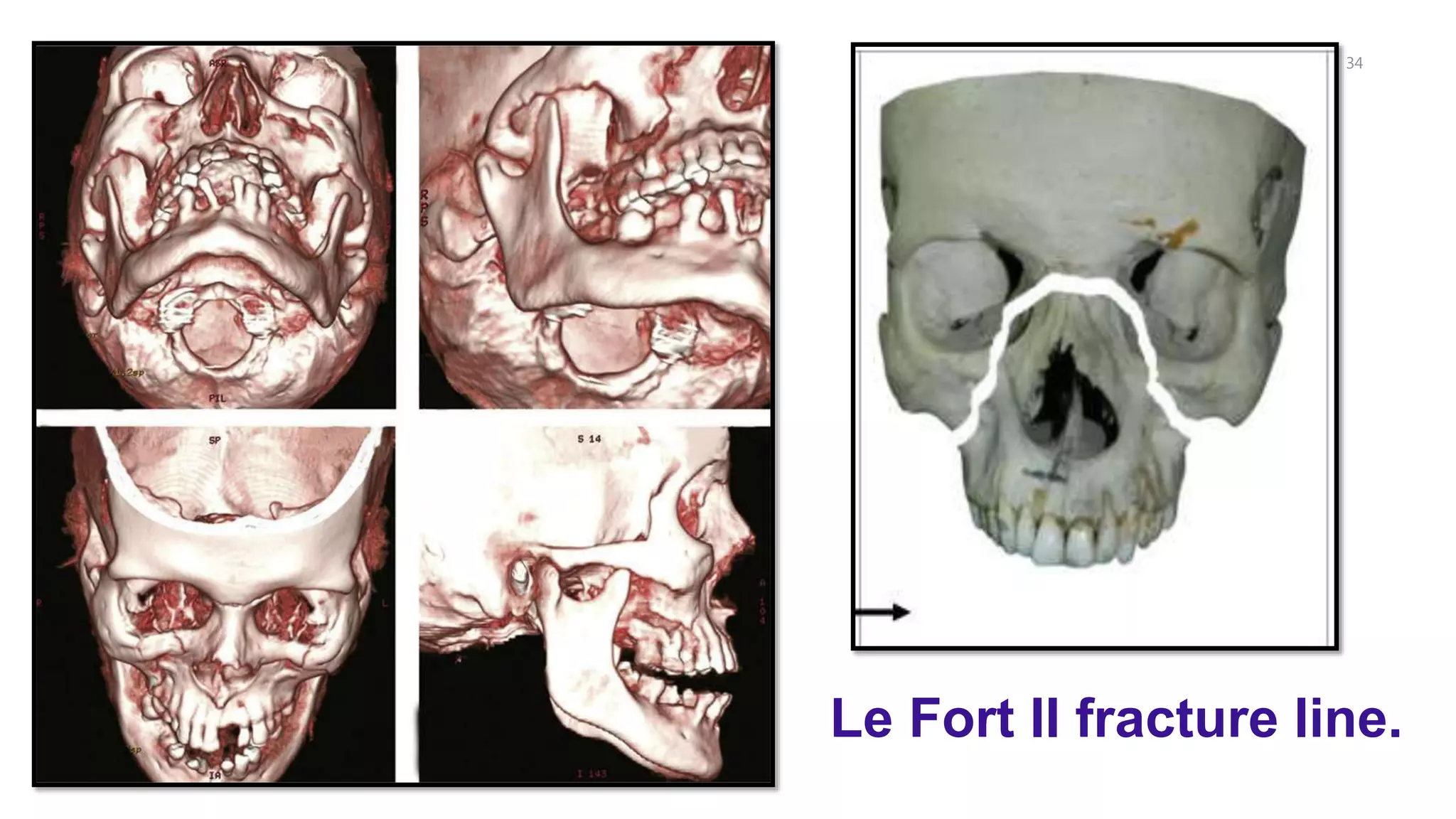 34
Le Fort II fracture line.
 