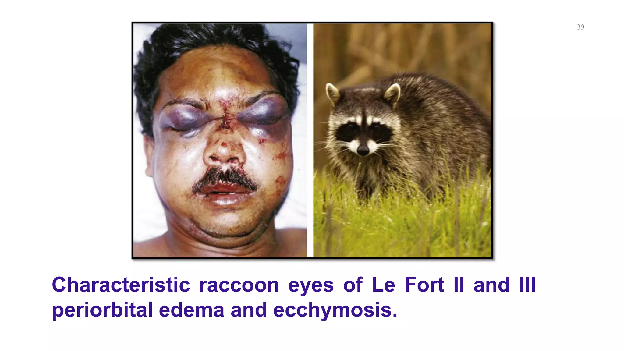 39
Characteristic raccoon eyes of Le Fort II and III
periorbital edema and ecchymosis.
 