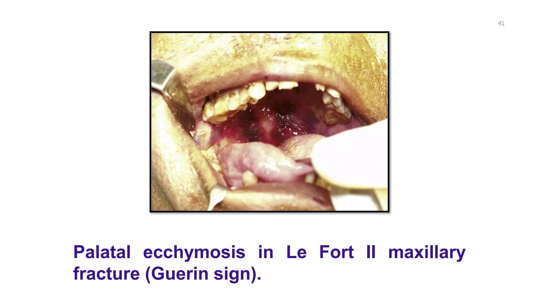 41
Palatal ecchymosis in Le Fort II maxillary
fracture (Guerin sign).
 